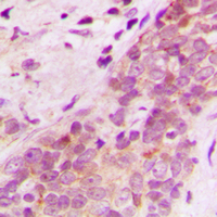 MAGI2 / AIP-1 Antibody - Immunohistochemical analysis of AIP-1 staining in human breast cancer formalin fixed paraffin embedded tissue section. The section was pre-treated using heat mediated antigen retrieval with sodium citrate buffer (pH 6.0). The section was then incubated with the antibody at room temperature and detected using an HRP conjugated compact polymer system. DAB was used as the chromogen. The section was then counterstained with hematoxylin and mounted with DPX.