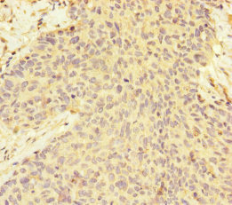 MAGOH Antibody - Immunohistochemistry of paraffin-embedded human ovarian cancer at dilution of 1:100