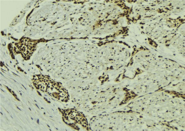 MAGOH Antibody - 1:100 staining human breast carcinoma tissue by IHC-P. The sample was formaldehyde fixed and a heat mediated antigen retrieval step in citrate buffer was performed. The sample was then blocked and incubated with the antibody for 1.5 hours at 22°C. An HRP conjugated goat anti-rabbit antibody was used as the secondary.