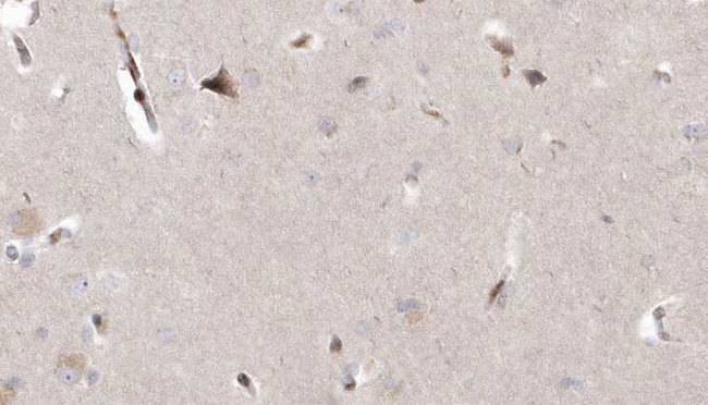 MAGT1 Antibody - 1:100 staining human brain carcinoma tissue by IHC-P. The sample was formaldehyde fixed and a heat mediated antigen retrieval step in citrate buffer was performed. The sample was then blocked and incubated with the antibody for 1.5 hours at 22°C. An HRP conjugated goat anti-rabbit antibody was used as the secondary.