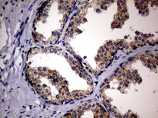 MAK Antibody - Immunohistochemical staining of paraffin-embedded Carcinoma of Human prostate tissue using anti-MAK mouse monoclonal antibody. (Heat-induced epitope retrieval by 1mM EDTA in 10mM Tris buffer. (pH8.5) at 120°C for 3 min. (1:150)
