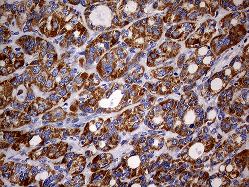 MAK Antibody - Immunohistochemical staining of paraffin-embedded Carcinoma of Human thyroid tissue using anti-MAK mouse monoclonal antibody. (Heat-induced epitope retrieval by 1mM EDTA in 10mM Tris buffer. (pH8.5) at 120°C for 3 min. (1:150)