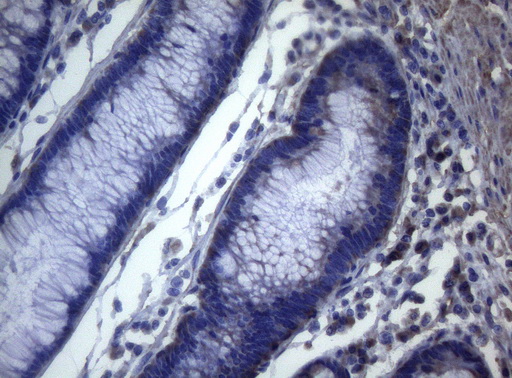 MAK Antibody - Immunohistochemical staining of paraffin-embedded Adenocarcinoma of Human colon tissue using anti-MAK mouse monoclonal antibody. (Heat-induced epitope retrieval by 1mM EDTA in 10mM Tris buffer. (pH8.5) at 120°C for 3 min. (1:150)