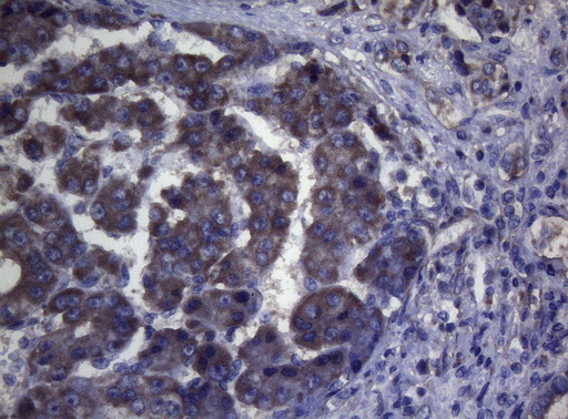 MAK Antibody - Immunohistochemical staining of paraffin-embedded Carcinoma of Human liver tissue using anti-MAK mouse monoclonal antibody. (Heat-induced epitope retrieval by 1mM EDTA in 10mM Tris buffer. (pH8.5) at 120°C for 3 min. (1:150)