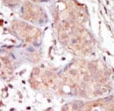 MAK Antibody - Formalin-fixed and paraffin-embedded human cancer tissue reacted with the primary antibody, which was peroxidase-conjugated to the secondary antibody, followed by DAB staining. This data demonstrates the use of this antibody for immunohistochemistry; clinical relevance has not been evaluated. BC = breast carcinoma; HC = hepatocarcinoma.