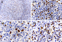 MALT1 Antibody - IHC of MALT1/Paracaspase expression in formalin-fixed human reactive lymph node using Polyclonal Antibody to MALT1/Paracaspase at 1:2000. A. Low magnification. A1-3, high magnification from A: A1, mantle zone. A2, germinal center. A3. marginal zone. Hematoxylin-Eosin counterstain.