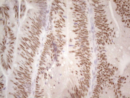 MALT1 Antibody - Immunohistochemical staining of paraffin-embedded Carcinoma of Human pancreas tissue using anti-MALT1 mouse monoclonal antibody. (Heat-induced epitope retrieval by 1mM EDTA in 10mM Tris buffer. (pH8.5) at 120°C for 3 min. (1:150)