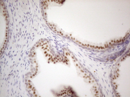 MALT1 Antibody - Immunohistochemical staining of paraffin-embedded Carcinoma of Human prostate tissue using anti-MALT1 mouse monoclonal antibody. (Heat-induced epitope retrieval by 1mM EDTA in 10mM Tris buffer. (pH8.5) at 120°C for 3 min. (1:150)