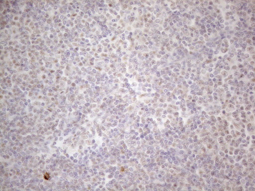 MALT1 Antibody - Immunohistochemical staining of paraffin-embedded Human lymphoma tissue using anti-MALT1 mouse monoclonal antibody. (Heat-induced epitope retrieval by 1mM EDTA in 10mM Tris buffer. (pH8.5) at 120°C for 3 min. (1:150)