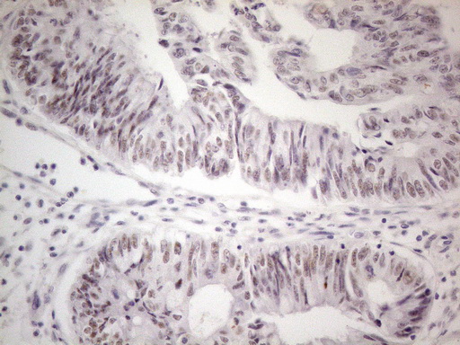 MALT1 Antibody - Immunohistochemical staining of paraffin-embedded Adenocarcinoma of Human colon tissue using anti-MALT1 mouse monoclonal antibody. (Heat-induced epitope retrieval by 1mM EDTA in 10mM Tris buffer. (pH8.5) at 120°C for 3 min. (1:150)