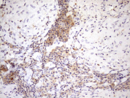 MALT1 Antibody - Immunohistochemical staining of paraffin-embedded Human lymph node tissue within the normal limits using anti-MALT1 mouse monoclonal antibody. (Heat-induced epitope retrieval by 1mM EDTA in 10mM Tris buffer. (pH8.5) at 120°C for 3 min. (1:150)