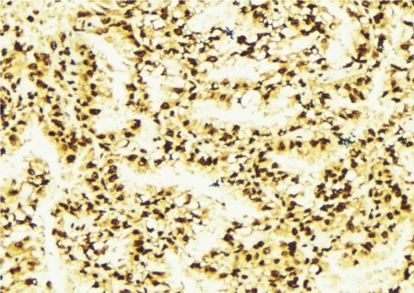 MALT1 Antibody - 1:100 staining human lung tissue by IHC-P. The sample was formaldehyde fixed and a heat mediated antigen retrieval step in citrate buffer was performed. The sample was then blocked and incubated with the antibody for 1.5 hours at 22°C. An HRP conjugated goat anti-rabbit antibody was used as the secondary.