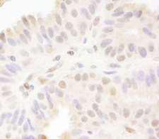 MAML1 Antibody - Detection of Human MAML1 by Immunohistochemistry. Sample: FFPE section of human breast carcinoma. Antibody: Affinity purified rabbit anti-MAML1 used at a dilution of 1:200 (1 Detection: DAB.