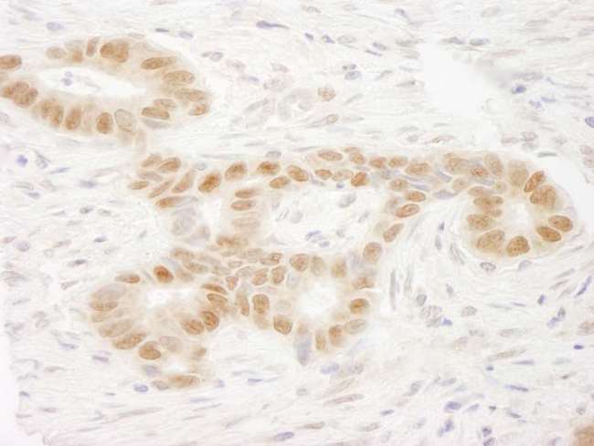 MAML2 Antibody - Detection of Human MAML2 by Immunohistochemistry. Sample: FFPE section of human stomach carcinoma. Antibody: Affinity purified rabbit anti-MAML2 used at a dilution of 1:250.