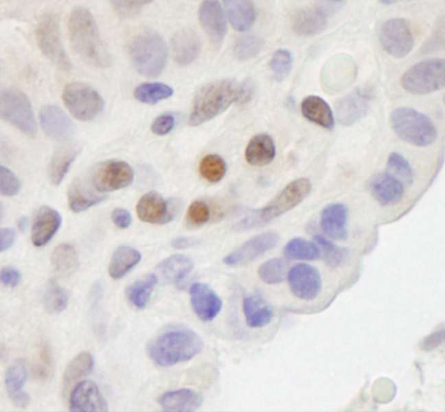 MAML2 Antibody - Detection of Human MAML2 by Immunohistochemistry. Sample: FFPE section of human breast carcinoma. Antibody: Affinity purified rabbit anti-MAML2 used at a dilution of 1:200 (1 Detection: DAB.
