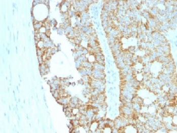 MAML2 Antibody - IHC testing of FFPE human colon carcinoma with MAML2 antibody (clone MAML2/1302). Staining of FFPE tissue requires boiling sections in 10mM Tris with 1mM EDTA, pH9, for 10-20 min followed by cooling at RT for 20 min.
