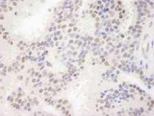 MAML3 / CAGH3 Antibody - Detection of Human MAML3 by Immunohistochemistry. Sample: FFPE section of human breast carcinoma. Antibody: Affinity purified rabbit anti-MAML3 used at a dilution of 1:500.
