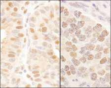 MAML3 / CAGH3 Antibody - Detection of Human and Mouse MAML3 by Immunohistochemistry. Sample: FFPE section of human breast carcinoma and mouse teratoma. Antibody: Affinity purified rabbit anti-MAML3 used at a dilution of 1:200 (1 Detection: DAB.