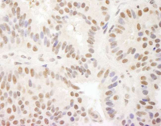 MAML3 / CAGH3 Antibody - Detection of Human MAML3 by Immunohistochemistry. Sample: FFPE section of human breast carcinoma. Antibody: Affinity purified rabbit anti-MAML3 used at a dilution of 1:1000 (1 Detection: DAB.