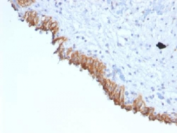 MAML3 / CAGH3 Antibody - IHC testing of FFPE human bladder carcinoma with MAML2 antibody (clone MAML2/1302). Staining of FFPE tissue requires boiling sections in 10mM Tris with 1mM EDTA, pH9, for 10-20 min followed by cooling at RT for 20 min.