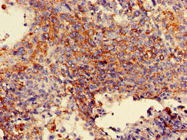 MAN2A1 / Mannosidase II Antibody - Immunohistochemistry of paraffin-embedded human cervical cancer at dilution of 1:100
