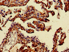 MAN2A1 / Mannosidase II Antibody - Immunohistochemistry of paraffin-embedded human lung cancer at dilution of 1:100