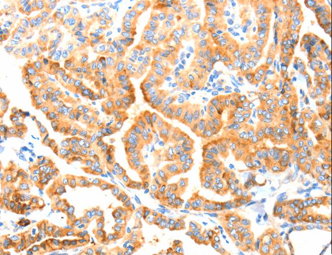 MANF / ARMET Antibody - Immunohistochemistry of paraffin-embedded Human colon cancer using MANF Polyclonal Antibody at dilution of 1:70.