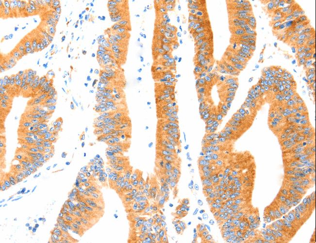MANF / ARMET Antibody - Immunohistochemistry of paraffin-embedded Human colon cancer using MANF Polyclonal Antibody at dilution of 1:70.