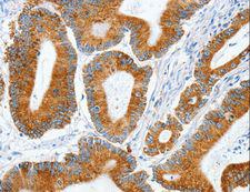 MANF / ARMET Antibody - Immunohistochemistry of paraffin-embedded Human lung cancer using MANF Polyclonal Antibody at dilution of 1:50.