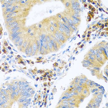 MANF / ARMET Antibody - Immunohistochemistry of paraffin-embedded human colon carcinoma using MANF antibody at dilution of 1:100 (40x lens).