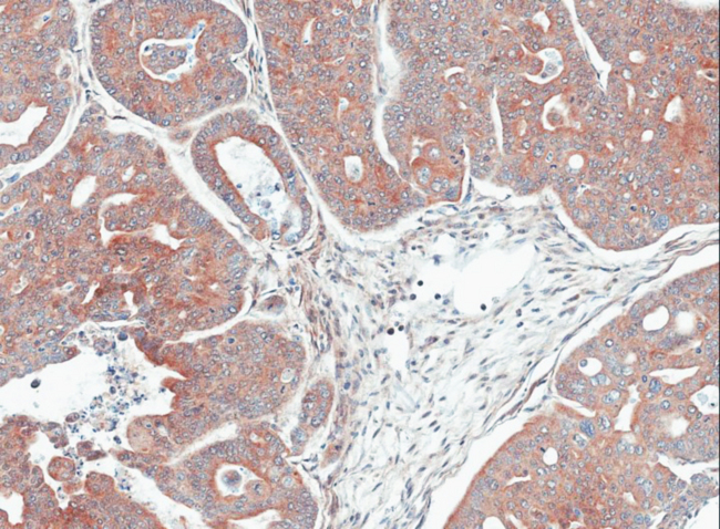Mannose Phosphate Isomerase Antibody - IHC of paraffin-embedded Gastric CA N87 xenograft using MPI antibody at 1:100 dilution.