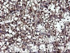 Mannose Phosphate Isomerase Antibody - IHC of paraffin-embedded Carcinoma of Human kidney tissue using anti-MPI mouse monoclonal antibody.