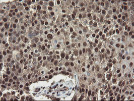 Mannose Phosphate Isomerase Antibody - IHC of paraffin-embedded Carcinoma of Human lung tissue using anti-MPI mouse monoclonal antibody.