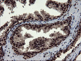 Mannose Phosphate Isomerase Antibody - IHC of paraffin-embedded Carcinoma of Human prostate tissue using anti-MPI mouse monoclonal antibody.