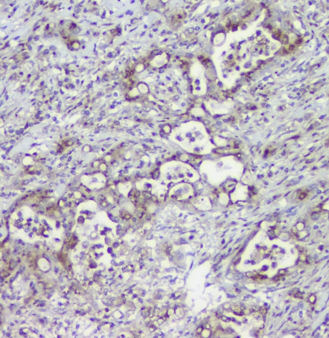Mannose Phosphate Isomerase Antibody - IHC analysis of MPI using anti-MPI antibody. MPI was detected in paraffin-embedded section of human intestinal cancer tissues. Heat mediated antigen retrieval was performed in citrate buffer (pH6, epitope retrieval solution) for 20 mins. The tissue section was blocked with 10% goat serum. The tissue section was then incubated with 1µg/ml rabbit anti-MPI Antibody overnight at 4°C. Biotinylated goat anti-rabbit IgG was used as secondary antibody and incubated for 30 minutes at 37°C. The tissue section was developed using Strepavidin-Biotin-Complex (SABC) with DAB as the chromogen.