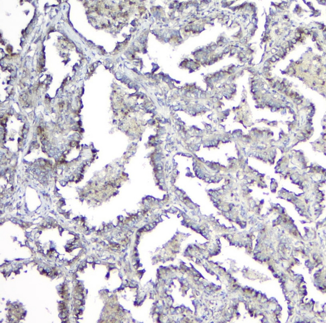 Mannose Phosphate Isomerase Antibody - IHC analysis of MPI using anti-MPI antibody. MPI was detected in paraffin-embedded section of human lung cancer tissues. Heat mediated antigen retrieval was performed in citrate buffer (pH6, epitope retrieval solution) for 20 mins. The tissue section was blocked with 10% goat serum. The tissue section was then incubated with 1µg/ml rabbit anti-MPI Antibody overnight at 4°C. Biotinylated goat anti-rabbit IgG was used as secondary antibody and incubated for 30 minutes at 37°C. The tissue section was developed using Strepavidin-Biotin-Complex (SABC) with DAB as the chromogen.