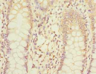 Mannose Phosphate Isomerase Antibody - Immunohistochemistry of paraffin-embedded human colon cancer at dilution 1:100