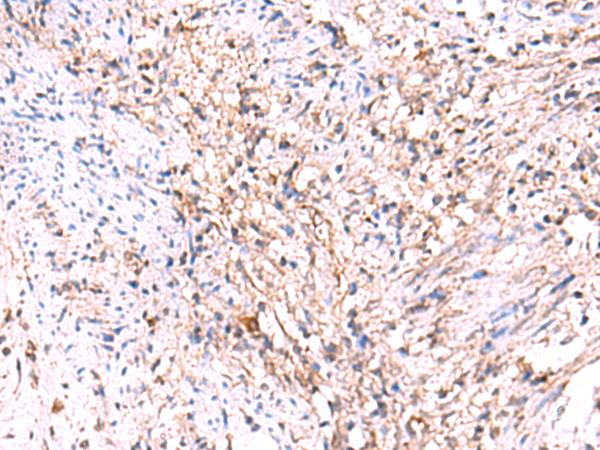 MANSC1 Antibody - Immunohistochemistry of paraffin-embedded Human cervical cancer tissue  using MANSC1 Polyclonal Antibody at dilution of 1:105(×200)