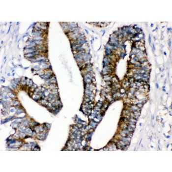 MAOA / Monoamine Oxidase Antibody - MAOA antibody IHC-paraffin. IHC(P): Human Intestinal Cancer Tissue.