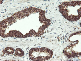 MAOA / Monoamine Oxidase Antibody - IHC of paraffin-embedded Carcinoma of Human prostate tissue using anti-MAOA mouse monoclonal antibody.