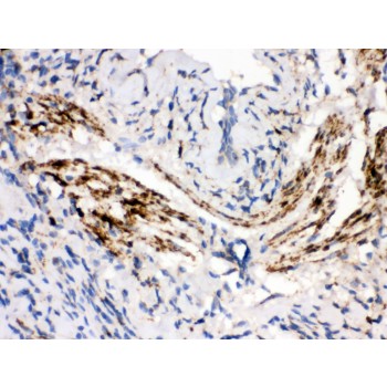 MAOB / Monoamine Oxidase B Antibody - MAOB antibody IHC-paraffin. IHC(P): Human Lung Cancer Tissue.