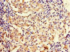 MAP10 / KIAA1383 Antibody - Immunohistochemistry of paraffin-embedded human lung cancer using MAP10 Antibody at dilution of 1:100
