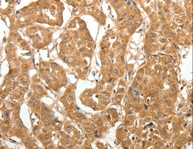 MAP1B Antibody - Immunohistochemistry of paraffin-embedded Human lung cancer using MAP1B Polyclonal Antibody at dilution of 1:60.