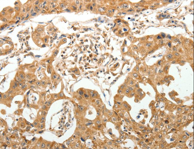 MAP1B Antibody - Immunohistochemistry of paraffin-embedded Human lung cancer using MAP1B Polyclonal Antibody at dilution of 1:40.