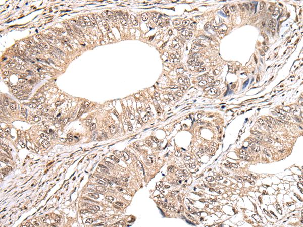 MAP1D Antibody - Immunohistochemistry of paraffin-embedded Human colorectal cancer tissue  using METAP1D Polyclonal Antibody at dilution of 1:40(×200)