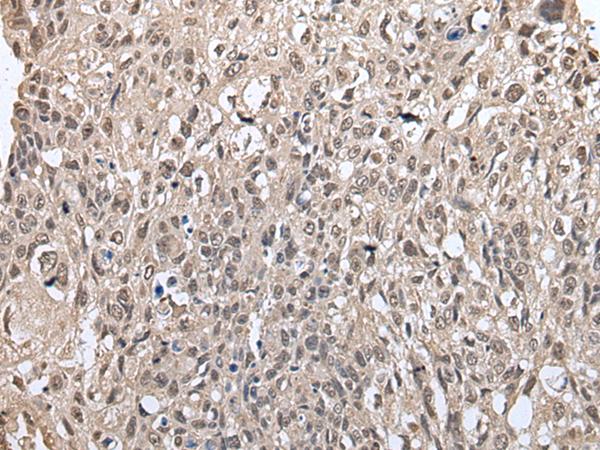 MAP1D Antibody - Immunohistochemistry of paraffin-embedded Human lung cancer tissue  using METAP1D Polyclonal Antibody at dilution of 1:60(×200)