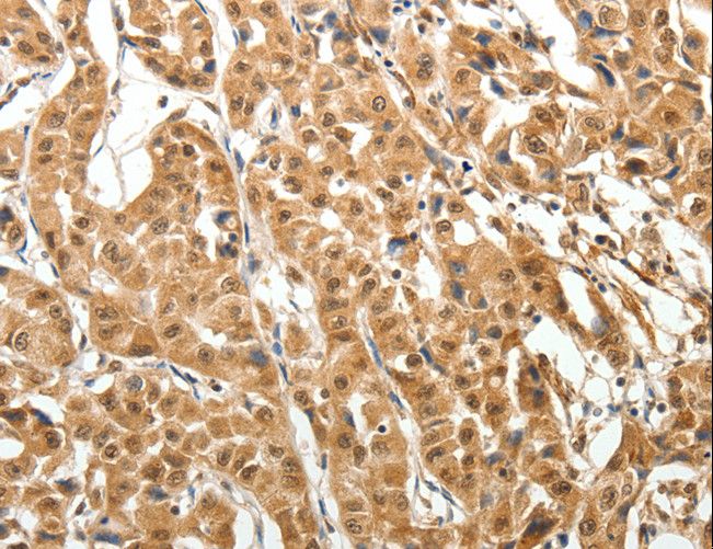 MAP1L / MAP1A Antibody - Immunohistochemistry of paraffin-embedded Human thyroid cancer using MAP1A Polyclonal Antibody at dilution of 1:40.