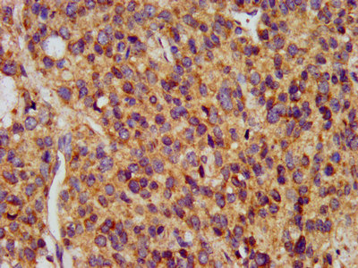 MAP1L / MAP1A Antibody - Immunohistochemistry image at a dilution of 1:400 and staining in paraffin-embedded human glioma cancer performed on a Leica BondTM system. After dewaxing and hydration, antigen retrieval was mediated by high pressure in a citrate buffer (pH 6.0) . Section was blocked with 10% normal goat serum 30min at RT. Then primary antibody (1% BSA) was incubated at 4 °C overnight. The primary is detected by a biotinylated secondary antibody and visualized using an HRP conjugated SP system.