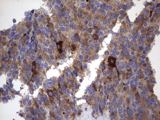 MAP1LC3A / LC3A Antibody - IHC of paraffin-embedded Adenocarcinoma of Human breast tissue using anti-MAP1LC3A mouse monoclonal antibody. (Heat-induced epitope retrieval by 1 mM EDTA in 10mM Tris, pH8.5, 120°C for 3min).