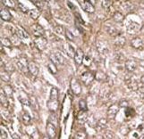 MAP1LC3B / LC3B Antibody - Formalin-fixed and paraffin-embedded human cancer tissue reacted with the primary antibody, which was peroxidase-conjugated to the secondary antibody, followed by DAB staining. This data demonstrates the use of this antibody for immunohistochemistry; clinical relevance has not been evaluated. BC = breast carcinoma; HC = hepatocarcinoma.